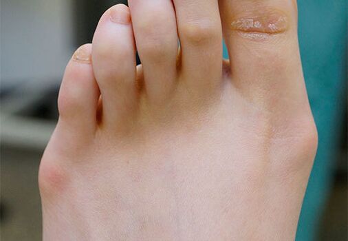 Pied valgus