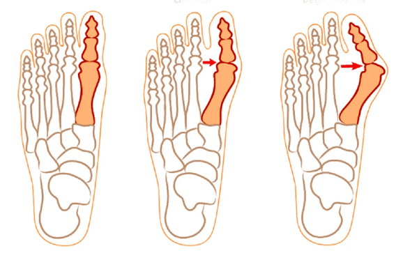 Déformation de l'hallux valgus
