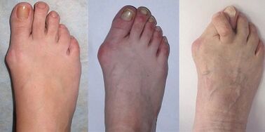 stades de l'hallux valgus