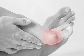 Hallux valgus comment choisir des chaussures