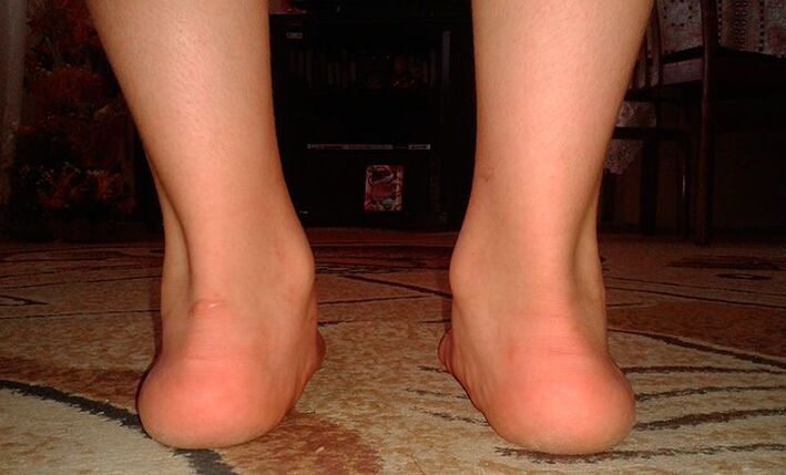 Pieds plats valgus