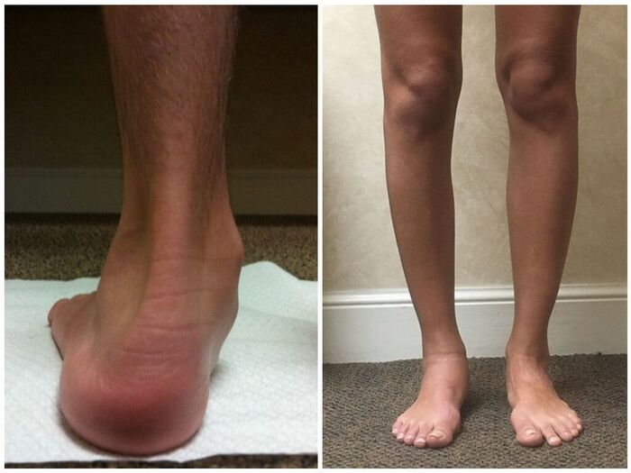 Jambes avec hallux valgus