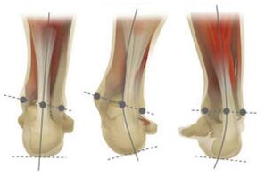 Pied normal, avec déviation en valgus et varus du calcanéum