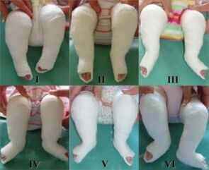 Procédures de plâtrage, chacune modifiant la position du pied