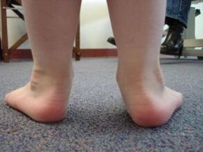 Valgus du pied plat chez un enfant