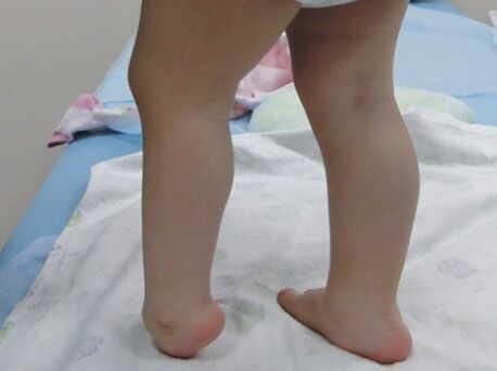 Les premiers symptômes de la déformation de Valgus del Pieda