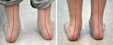Courbures de valgus