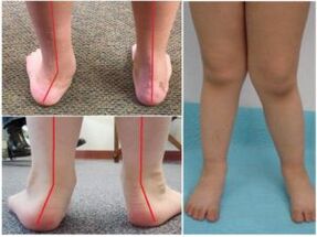Valgus